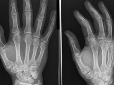 Base of Thumb Fractures
