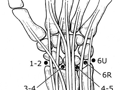 Exploring Minimally Invasive Wrist Surgery: Understanding Arthroscopy