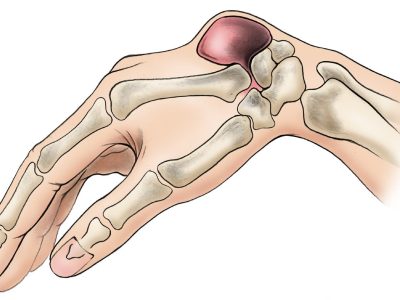Treating and Understanding Thumb Ligament Injuries