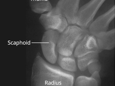 Understanding and Managing Wrist Ligament Injuries