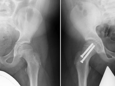 Understanding and Managing Slipped Capital Femoral Epiphysis (SCFE) in Adolescents