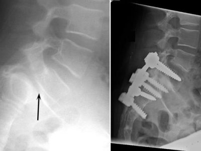 Spondylolysis and Spondylolisthesis