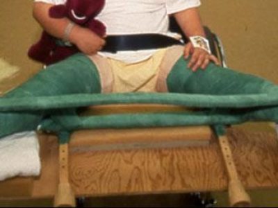 Understanding Perthes Disease: Causes, Stages, and Treatment Options