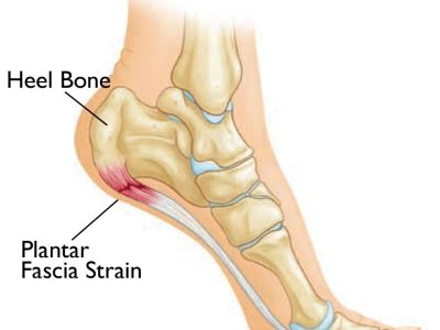 Understanding Heel Pain: Causes and Treatment of Plantar Fasciitis and Bone Spurs