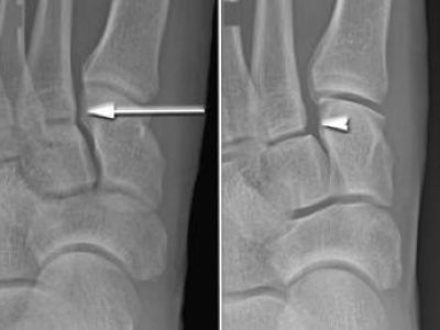 Understanding Lisfranc Injuries: Causes, Symptoms, and Treatment Options