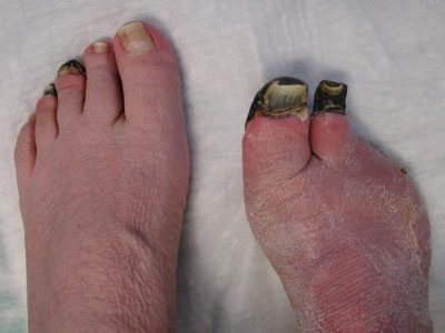 Understanding Frostbite: Symptoms, Risks, and Prevention Tips