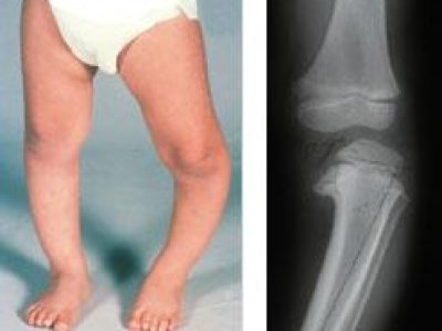 Understanding Bowed Legs in Children and Adolescents: Causes and When to Seek Help