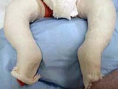 Understanding and Treating Clubfoot: Early Intervention and Effective Methods