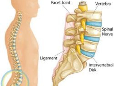 Sciatica