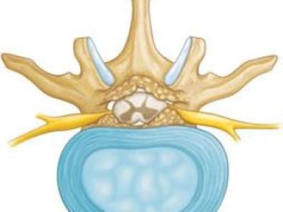 Understanding Lumbar Spinal Canal Narrowing: Causes, Symptoms, and Age-Related Risk Factors