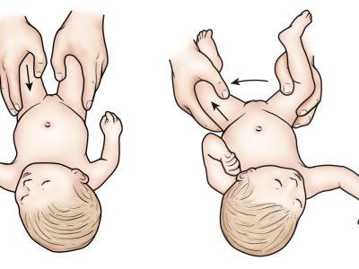 Understanding Hip Dysplasia in Infants: Causes, Risks, and Preventive Measures