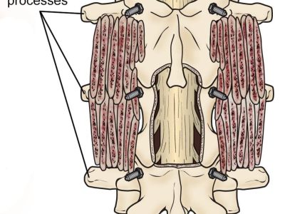 Understanding Spinal Fusion Surgery: Benefits, Procedures, and Conditions Treated