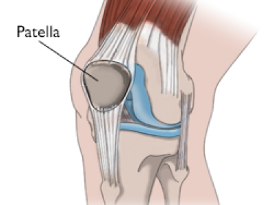 Understanding Kneecap Instability: Causes and Implications