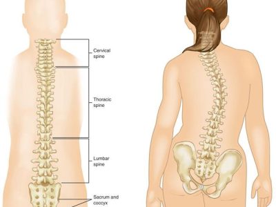 Understanding Neuromuscular Scoliosis in Children with Muscular and Neurological Conditions