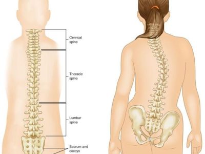 Understanding Pediatric Idiopathic Scoliosis: Causes, Symptoms, and Treatment Options