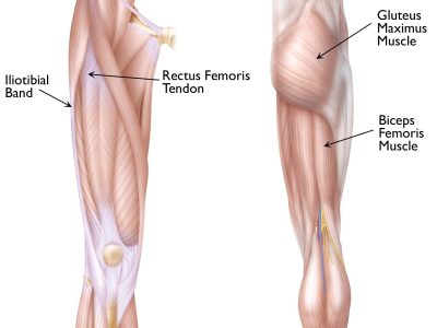 Understanding Femur Fractures in Children: Causes and Key Insights