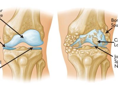 Knee Arthritis: Symptoms, Types, and Effective Management Strategies