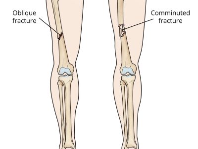 Understanding Femoral Shaft Fractures: Causes, Treatment, and Recovery