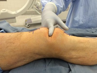Understanding Patellar Fractures: Causes, Symptoms, and Treatment Options