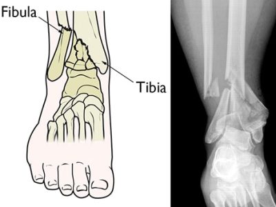 Understanding Pilon Fractures: Causes, Treatment, and Impact on Ankle Health