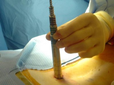 “Advances in Minimally Invasive Techniques for Spine Surgery: Benefits and Procedures”