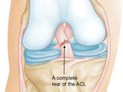 Understanding ACL Injuries: Causes, Risks, and Treatment Options