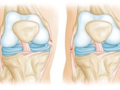 Understanding Collateral Ligament Injuries: Causes, Symptoms, and Treatment