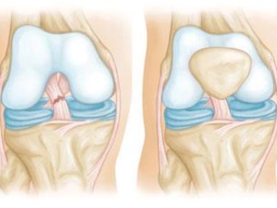 Revitalizing Movement After Combined Knee Ligament Injuries