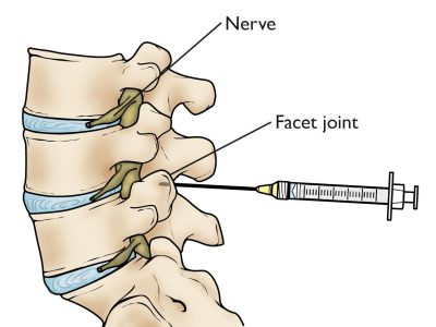 Understanding Spinal Injections: Uses, Benefits, and Risks