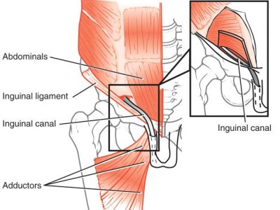 Understanding Athletic Pubalgia: A Comprehensive Guide to Sports Hernias
