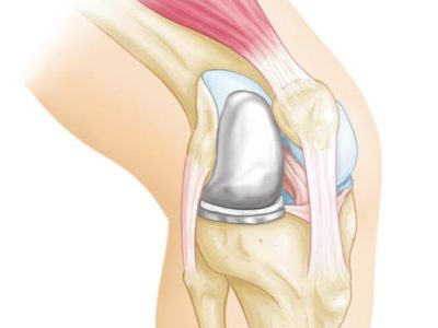 Unicompartmental Knee Replacement