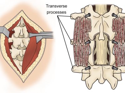 Posterolateral Lumbar Fusion: Procedure, Benefits, and Recovery