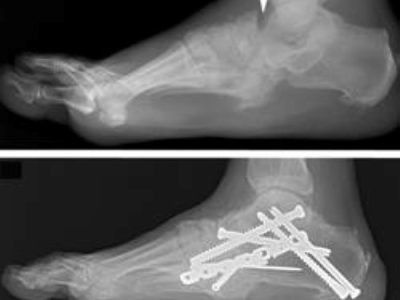 Understanding Charcot Foot: A Diabetic Complication and Its Prevention
