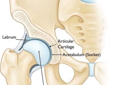 Understanding Hip Dysplasia in Adolescents: Causes, Symptoms, and Treatment Options