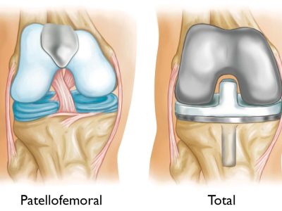 Understanding Patellofemoral Arthritis: Symptoms, Causes, and Challenges in Everyday Activities