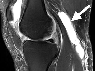 Understanding Baker’s Cyst: Causes, Symptoms, and Treatment Options