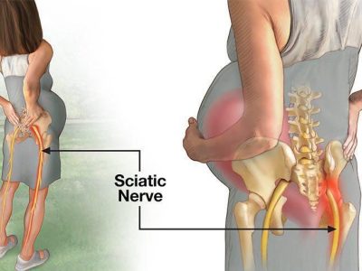 How to Cope With Sciatica Pain during Pregnancy