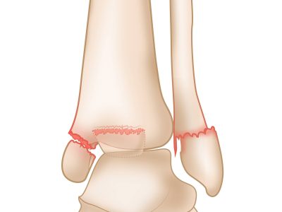 Understanding Ankle Fractures: Causes, Symptoms, and Treatment Options