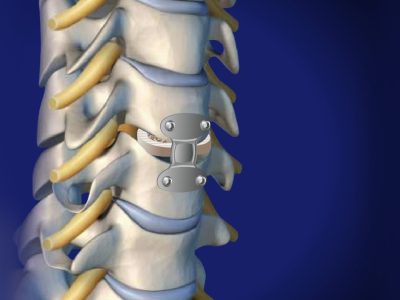 Cervical Corpectomy and Strut Graft