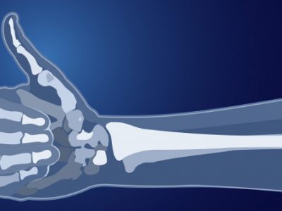 Chronic Illness and Bone Health