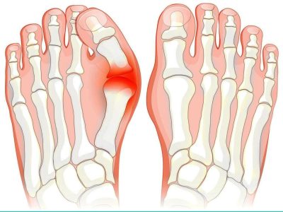 Bunion Surgery: Procedures Recovery and What to Expect