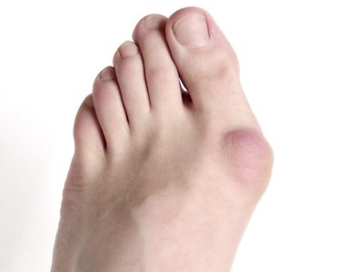 Bunions