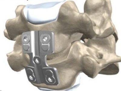 Anterior Cervical Discectomy and Fusion