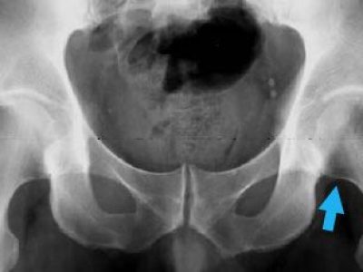 Understanding Transient Hip Bone Loss: Causes, Symptoms, and Recovery