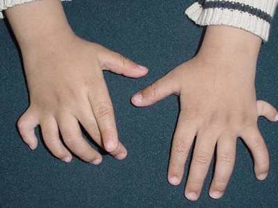 Understanding Congenital Hand Differences in Children