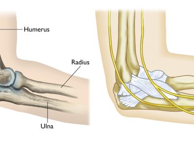 Insights into Olecranon Fractures