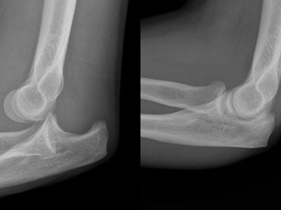 Simple Elbow Dislocation