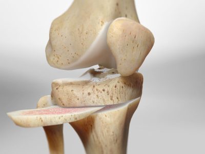 Knee Osteotomy: A Guide to Procedure and Benefits