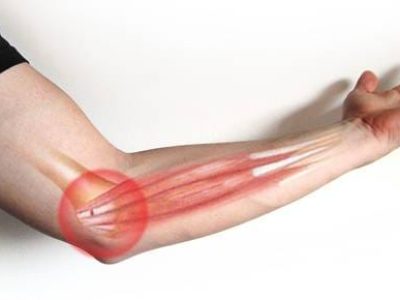 How to Recognize and Treat Golfer’s Elbow