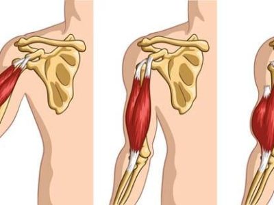 How to Recognize and Treat Arm Muscle Strains